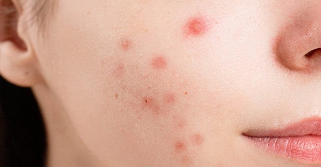 skin type